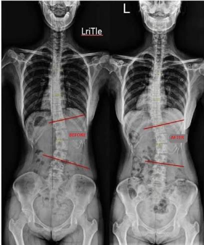 Μέθοδος Schroth