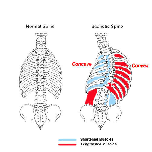 Μέθοδος Schroth