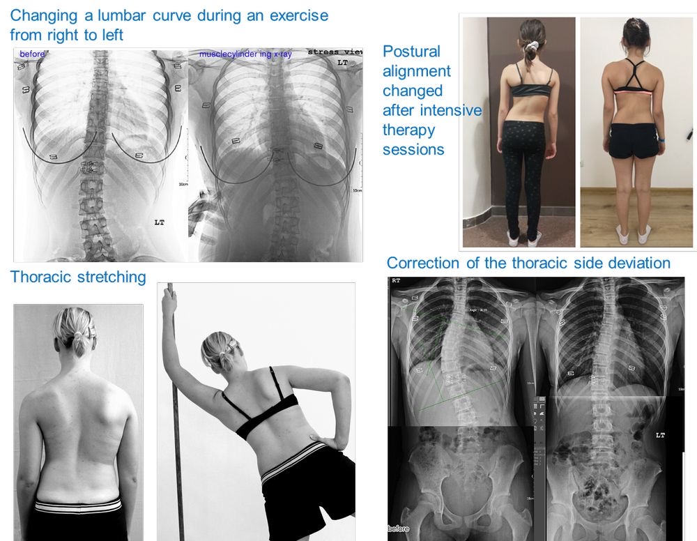 Μέθοδος Schroth